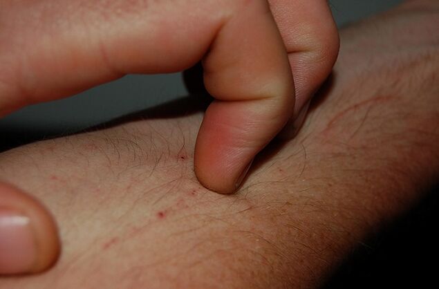 azkura azala parasitoen presentzia sintoma gisa