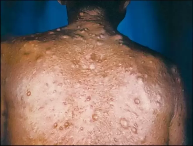 parasitoengatik larruazaleko nodo purulentak
